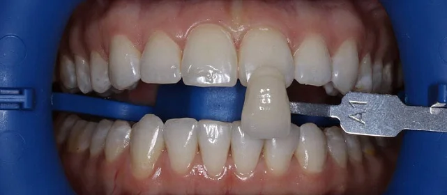 Восстановление цвета эмали с помощью отбеливания Zoom 4