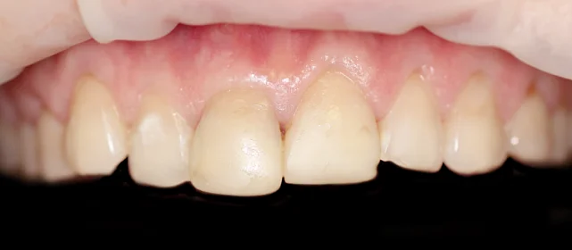 Протезирование зубов верхней челюсти винирами