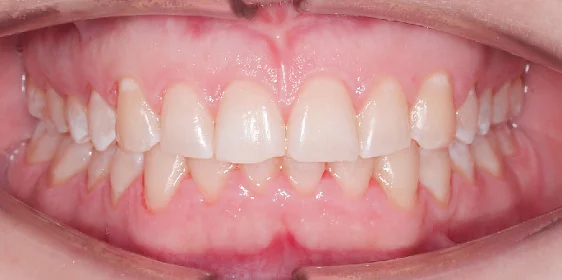 Исправление прикуса. 17 кап, 9 месяцев лечения