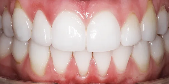 Лечение дистального прикуса с последующим ретенционным периодом