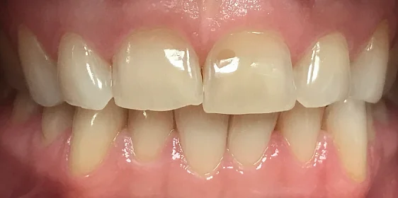 Нормализация смыкания и устранение скученности