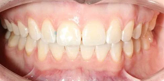 Коррекция дистального прикуса элайнерами