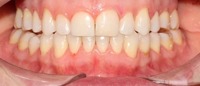 Лечение неправильного прикуса элайнерами