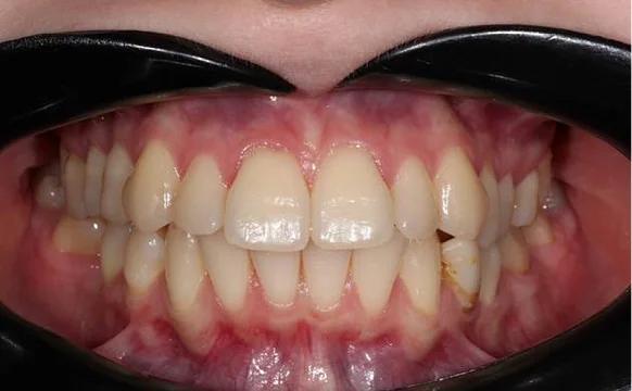 Лечение протрузии верхних резцов на брекет-системе