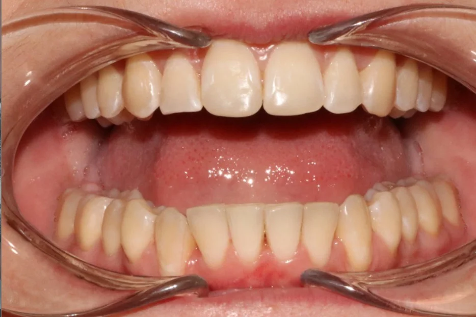 Лечение аномалии соотношения зубных дуг элайнерами