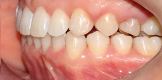 Ортодонтическое лечение на системе Click