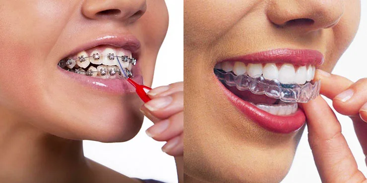 Отличие элайнеров от брекетов