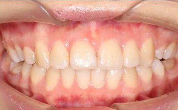 Ортодонтическое лечение на брекет-системе