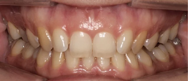 Ортодонтическое лечение на элайнерах №9