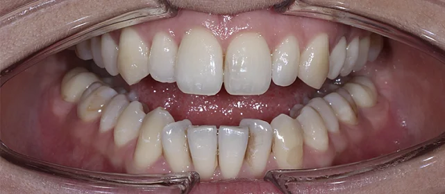 Расширение зубного ряда