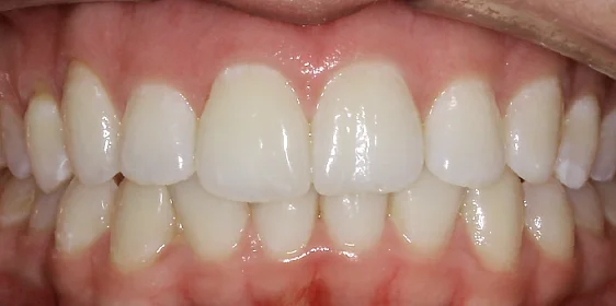 Устранение протрузии верхних резцов