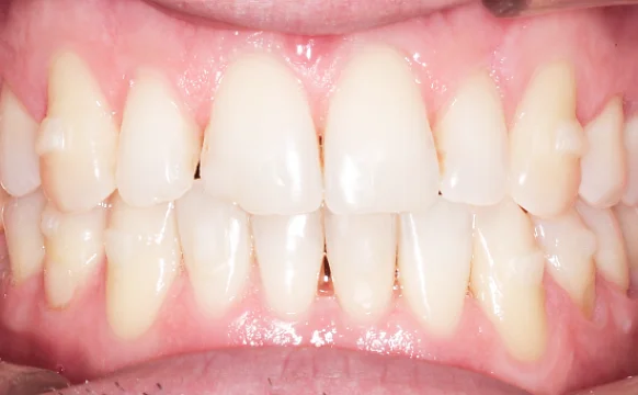 Исправление прикуса и имплантация