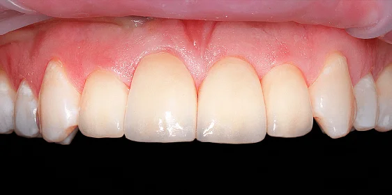 Восстановление эстетики с помощью виниров и вкладок (часть 1)