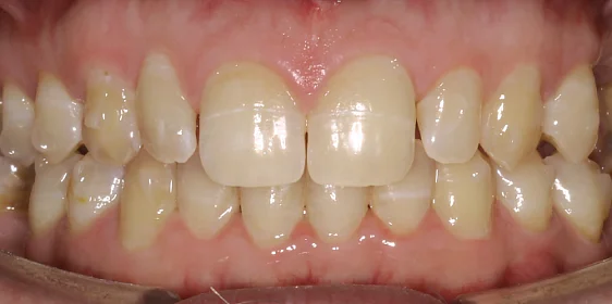 Ортодонтическая подготовка зубов к предстоящим ортопедии и имплантации