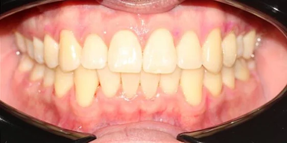 Ортодонтическое лечение на элайнерах