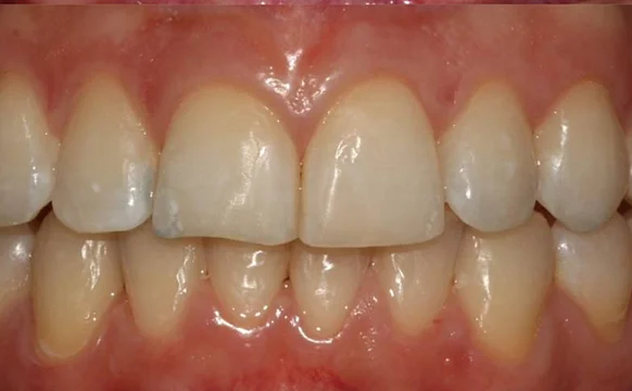 Ортодонтическое лечение на элайнерах