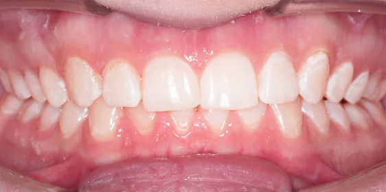 Исправление прикуса. 29 кап, 7 месяцев лечения