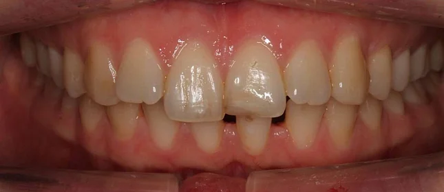 Лечение дистальной окклюзии на брекет-системе