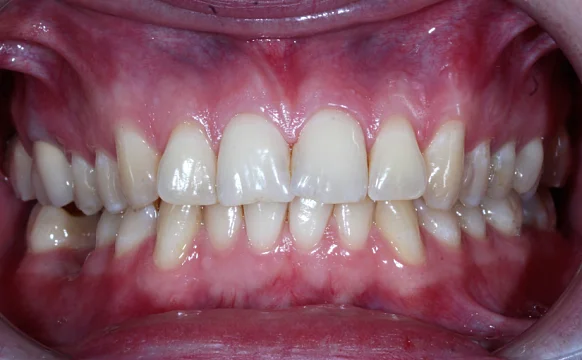 Лечение аномалии соотношений зубных дуг на брекет-системе