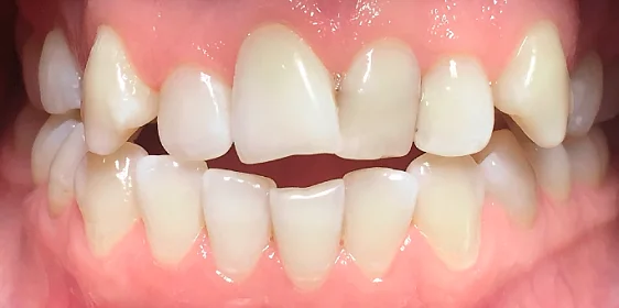 Лечение прикуса с последующей ортопедией верхних зубов