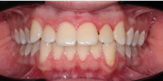 Ортодонтическое лечение на системе Click