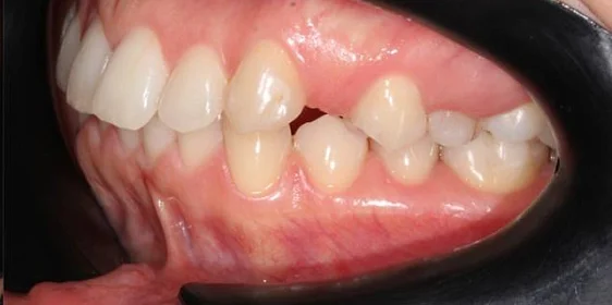 Ортодонтическое лечение на системе Click