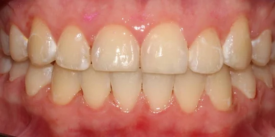 Ортодонтическое лечение на брекет-системе