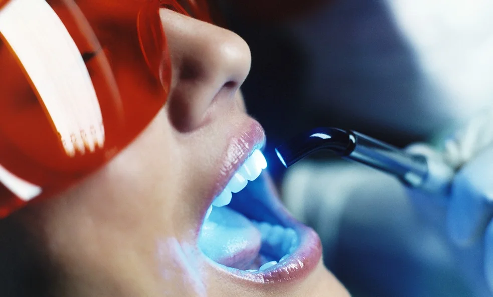 лазерное отбеливание