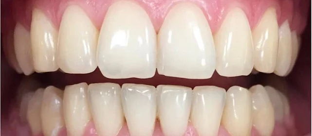 Отбеливание ZOOM4 после ортодонтии