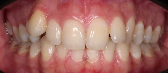 Ортодонтическое лечение на брекет-системе №2