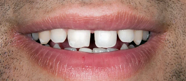 "Голливудская улыбка" с помощью виниров