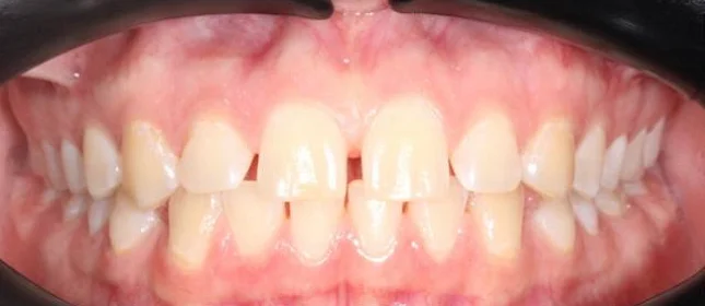 Лечение диастемы на верхней челюсти на элайнерах Click