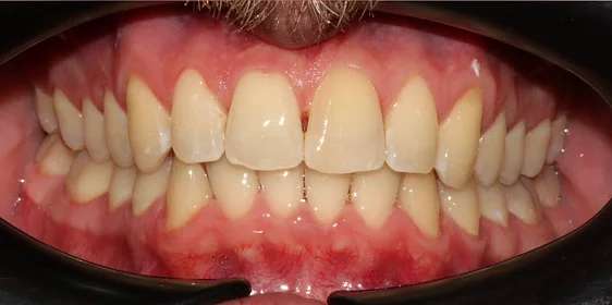 Ортодонтическое лечение на системе Click