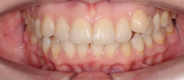 Лечение скученности зубов элайнерами