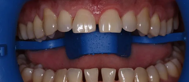 Отбеливание системой ZOOM4