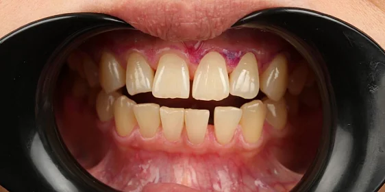 Ортодонтическое лечение на элайнерах