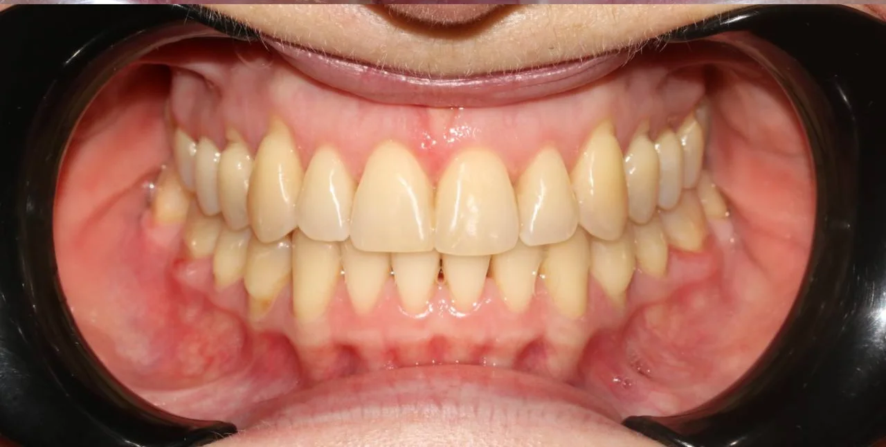 Ортодонтическое лечение на элайнерах