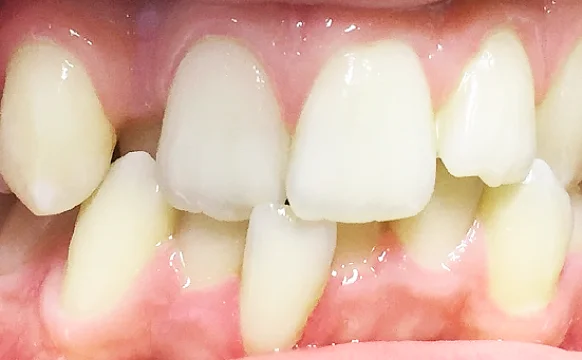 Завершающий этап лечения скученности и обратного перекрытия