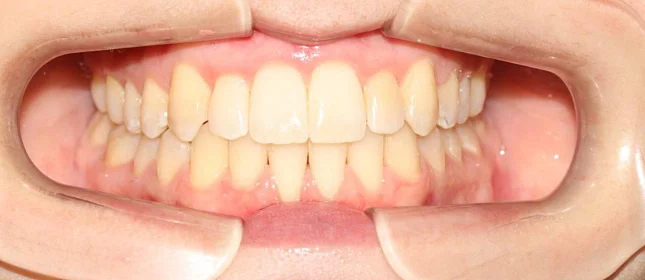 Корреция открытого прикуса элайнерами