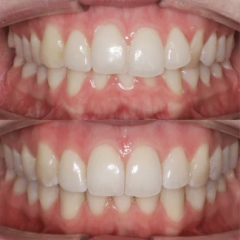 Расширение и выравнивание верхнего и нижнего зубных рядов