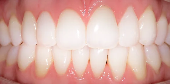 Выравнивание зубных рядов элайнерами Invisalign