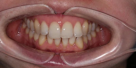 Лечение на Star Smile