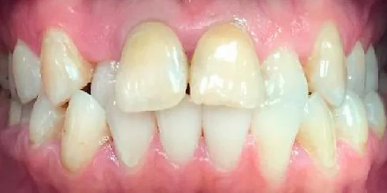 Исправление прикуса. 38 кап, 19 месяцев лечения