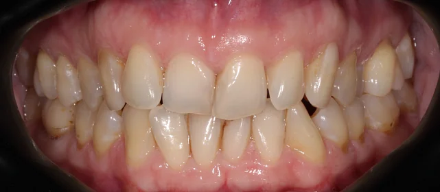 Коррекция аномалии соотношений зубных дуг элайнерами