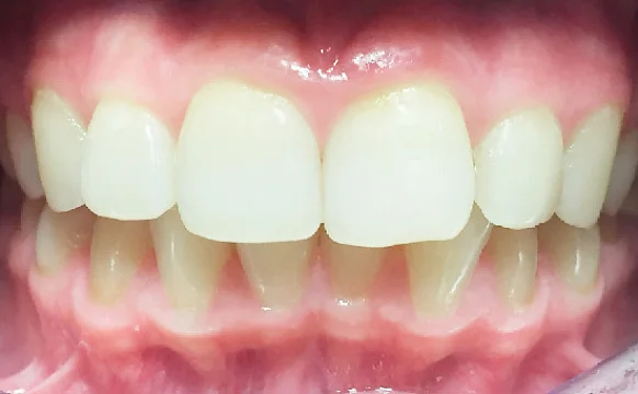 Лечение скученности зубов капами Инвизилайн