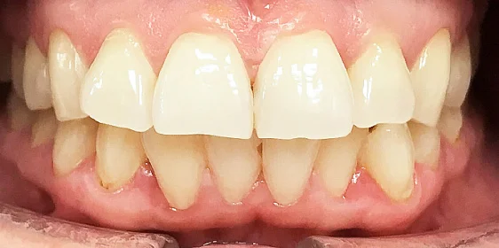 Устранение бипротрузии верхних и нижних резцов