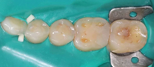 Эстетическая реставрация задних зубов