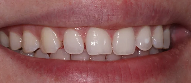 Реставрация