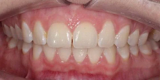 Коррекция дистального прикуса элайнерами