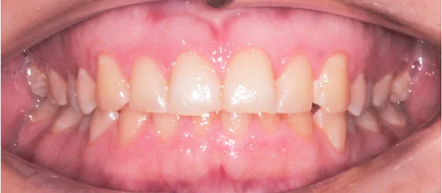 Исправление прикуса. 17 кап, 9 месяцев лечения